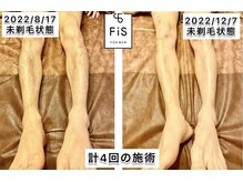 フィズ 国分寺店(FIS)/☆メンズの足の脱毛も☆
