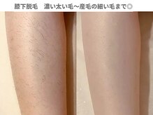 ピュアノア 垂水店/スピーディーな結果【美肌脱毛】