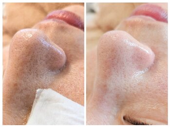 サロン ザ プマロ(SalonThePumalo)/毛穴エクストラクション＆ハリ感