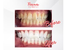 ティアナ 徳島店(Tiana)/ホワイトニング　Before&After
