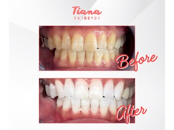 ティアナ 徳島店(Tiana)/ホワイトニング Before&After