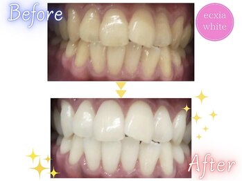 エクシアホワイトニング 天王寺店/ホワイトニングビフォーアフター