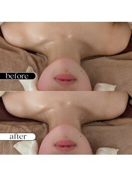 リサプリ(Re: Supple)/インディバ筋膜リンパ