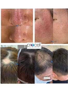 ルアナ(Ruana)の写真/【プロセル髪質肌質改善毛穴洗浄&黒ずみケア】世界初のバイオ成長因子とDNA修復酵素で最先端の頭皮&肌ケア