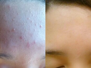 ボディーワークスナビ(Body Works Navi)/【ハーブピーリング】施術例