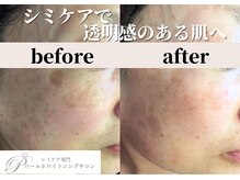 パールホワイトニングサロン 平塚店/シミケアとララピールで艶肌へ