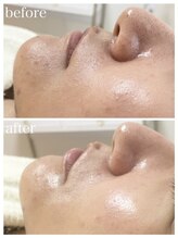 毛穴塾/毛穴撲滅コース(全顔)