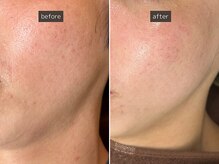 SEC(Shizuoka esthetic company)/【小顔×肌質改善】中顔面短縮