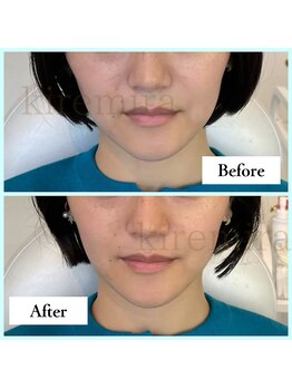 キレミラ 麻布十番店/たるみ編