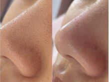 何をしてもダメだった毛穴も、毛穴レスへ導きます★