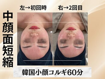 イヨヨ(iyoyo)/【小顔コルギ60分】Before After