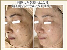 ポモナ 横浜馬車道店(Pomona)/手強いシミも解決◎