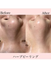 プティ 六本木店(Petit)/話題の韓国ハーブピーリング