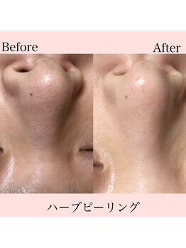 プティ 六本木店(Petit)/話題の韓国ハーブピーリング