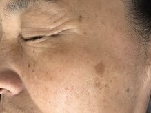 オアシスラグーン(OASIS LAGOON)/シミケア（症例７：before）