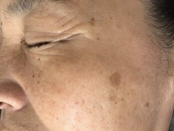 オアシスラグーン(OASIS LAGOON)/シミケア(症例7:before)