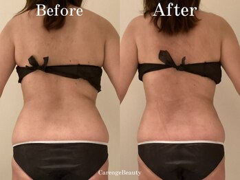 カレンジェビューティー(CarengeBeauty)/四日市痩身/スリムカッター