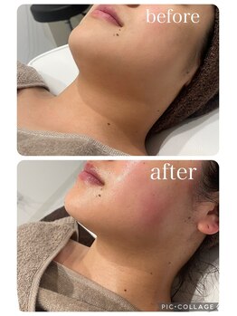 ランソ ビューティー 成田(RUNSO Beauty)/フェイスラインすっきり！