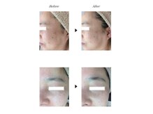 ビューティークリニックコダマ 国分店/【3ヶ月】K.U様 (50代) シワケア