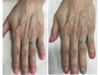 ハンドトリートメント