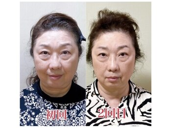 小顔22 ボルティ 本店(Bolty)/ビフォーアフター