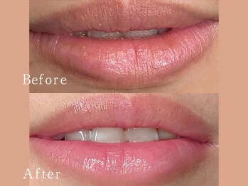 クリアー(CLEAR.)/【Before＆After】ローマピンク