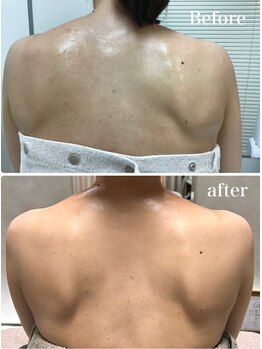 オーパーツ(OOPARTS)/血流ケアで背中のラインを整える