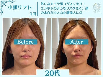 フローフシ∞/【小顔】切らない小顔リフト