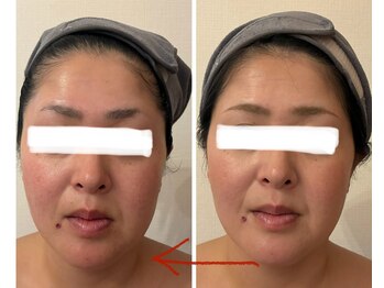 ユフラ(Juhla)/切らない小顔リフト