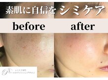 パールホワイトニングサロン 平塚店/ホワイトニングケアとシミケア