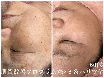 ヌー 栄(nuu)/シミ肌質改善プログラム4か月