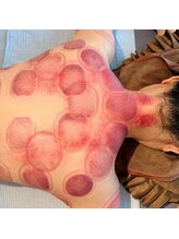 ビレイ(Birei)/カッサ＋カッピング