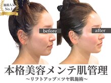 糸なしでリフトアップ【たるみ矯正】と、ツヤ肌管理を同時に◎