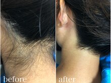 グレイティア(gratia)/うなじ脱毛で後ろ姿美人♪