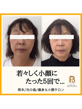 ブプラ 光の森店(BUPURA)/お客様ビフォーアフター