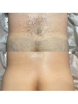 ピーディーエーサロン(PDA salon)/【背中、お尻脱毛】