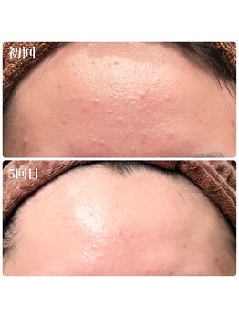 フルオール(FRUOR)/プラズマシャワー