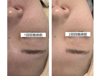 ココロ(COCORO)/角質肥厚/毛穴開き/色斑ケア