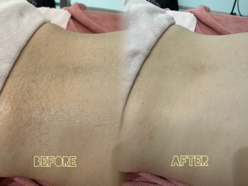 クイーン 渋谷店(QUEEN)/腰回りの産毛