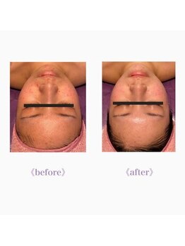 ライゼ(REISE)/ビフォーアフターご【ニキビ】