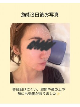 プレジール エテ(plaisir Ete)/ハープピーリング3日後