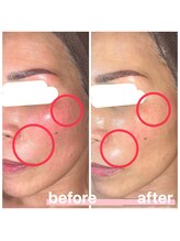 プリマ 大津店(PRIMA)/大人気！プラズマフェイシャル★