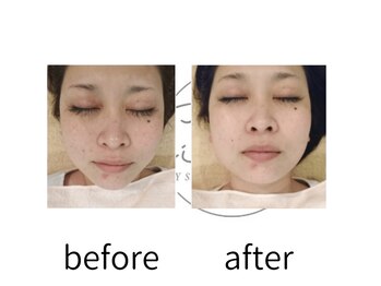 キッキー(Kicky)/韓国白玉肌マッサージ付き