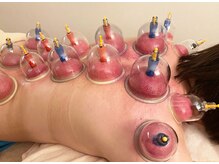 ラクラク健康堂 桜木町店(RAKURAKU健康堂)/即効性の高い吸い玉の施術