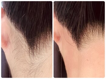 サロン ド アリーナ(Salon de Alina)/フェイスワックス脱毛