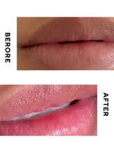 ホワイトニングショップ 町田店/【ローマピンクリップ】