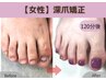 【再発させない深爪矯正】女性フット/足の深爪矯正　即日見た目改善