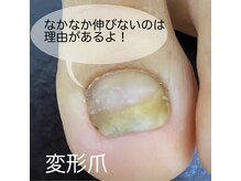 トルフル(TORUFUL)/お悩みが深い変形爪ケア