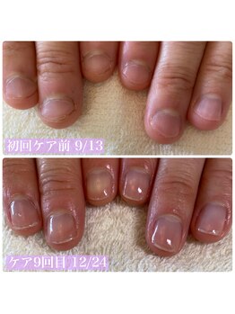 ココモネイル(cocomo nail)/子供の頃からの噛み爪を卒業！