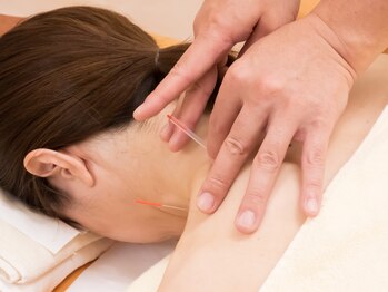 三越前はり灸整骨院/肩こりによる鍼施術